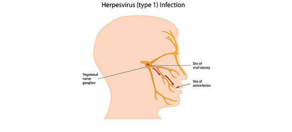 Herpesul