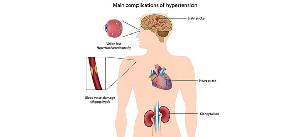 Hipertensiunea