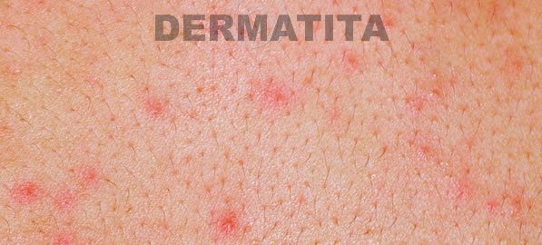 Dermatita de contact