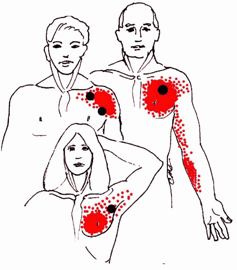 Angina Pectorala Academia Pacientului angina-pectorala-academia-pacientului