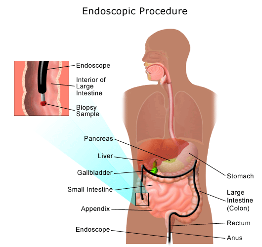 Boala Crohn si colita ulceroasa