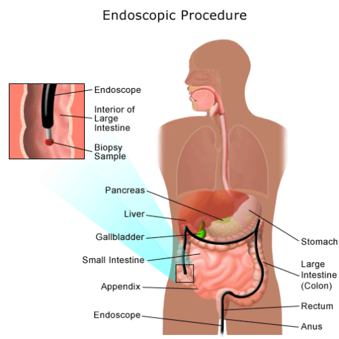 Boala Crohn si colita ulceroasa