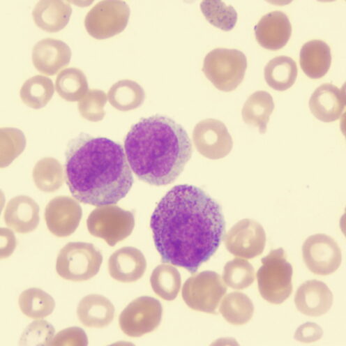 Leucemia