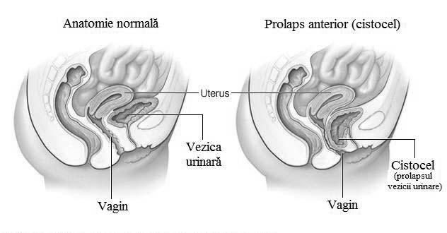 Prolapsul uterin