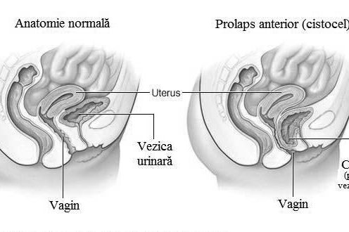 Prolapsul uterin