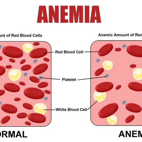 Anemia feripriva