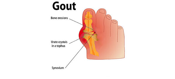 Tratament pentru guta