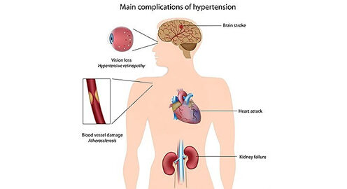 Hipertensiunea