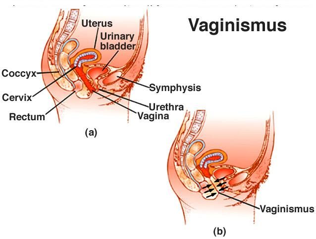 Vaginismul