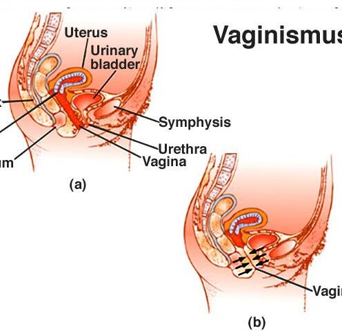 Vaginismul