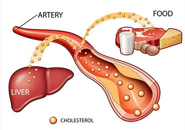 Hiperlipidemia ereditara