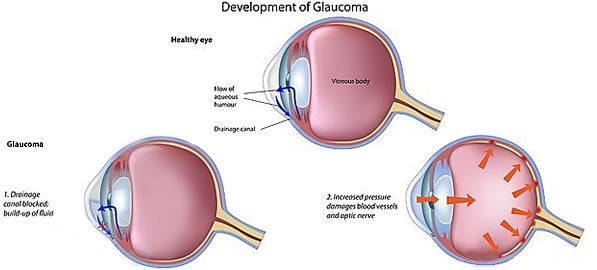 Glaucom – glaucomul acut