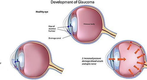 Glaucom – glaucomul acut