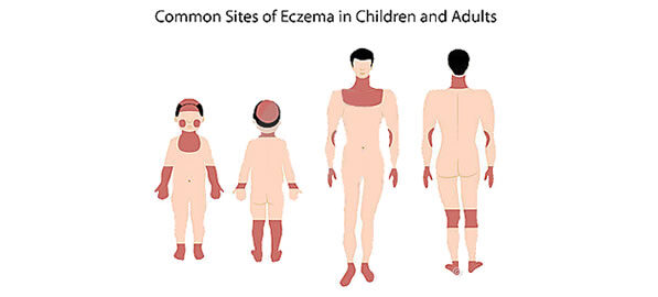 Eczema