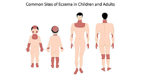 Eczema