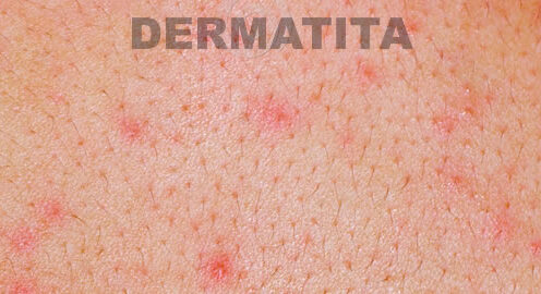 Dermatita de contact