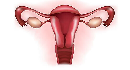 Fibroamele uterine