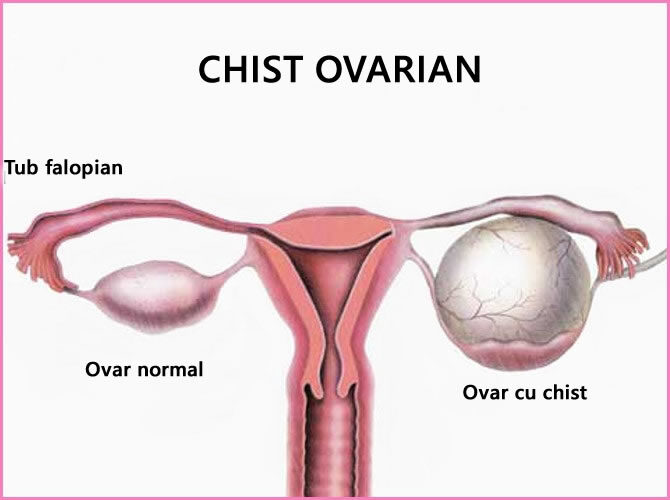 Ce sunt chisturile ovariane? Cand ar trebui sa ne alarmam?