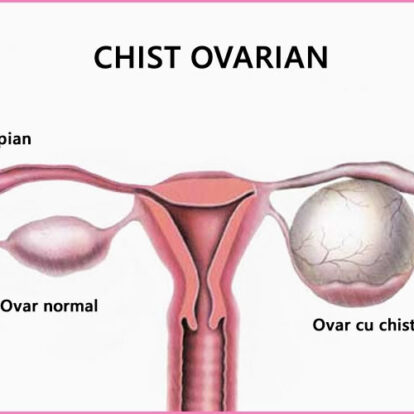 Ce sunt chisturile ovariane? Cand ar trebui sa ne alarmam?